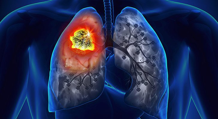15-things-you-need-to-know-about-lung-cancer_1.jpg