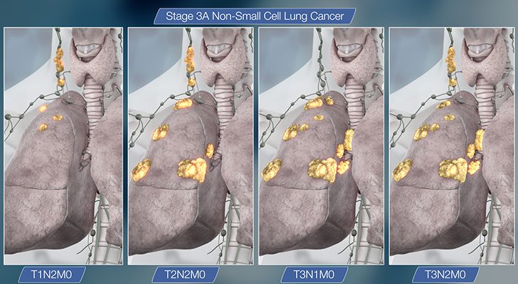 15-things-you-need-to-know-about-lung-cancer_10.jpg