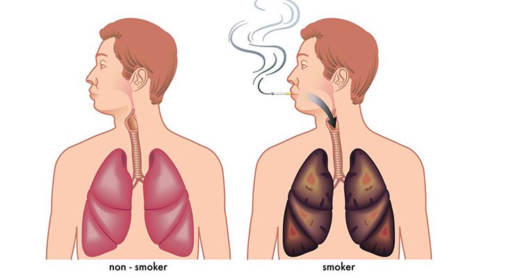 15-things-you-need-to-know-about-lung-cancer_4.jpg