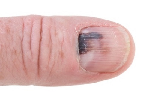 15 Disturbing Things Your Nails Reveal About Your Health – Page 2