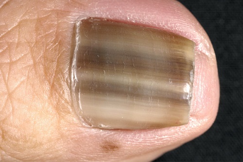 15 Disturbing Things Your Nails Reveal About Your Health - Fallbrook247