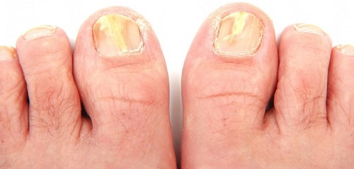 http://20176-presscdn.pagely.netdna-cdn.com/wp-content/uploads/2017/01/Best-Toenail-clippers-for-thick-fungal-diabetic-toenails.jpg
